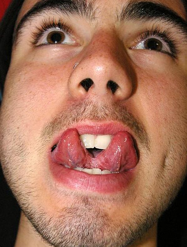 Tongue splitting