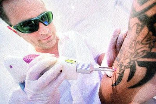 laser tattoo removal 1